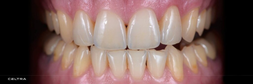 dentsply celtra
