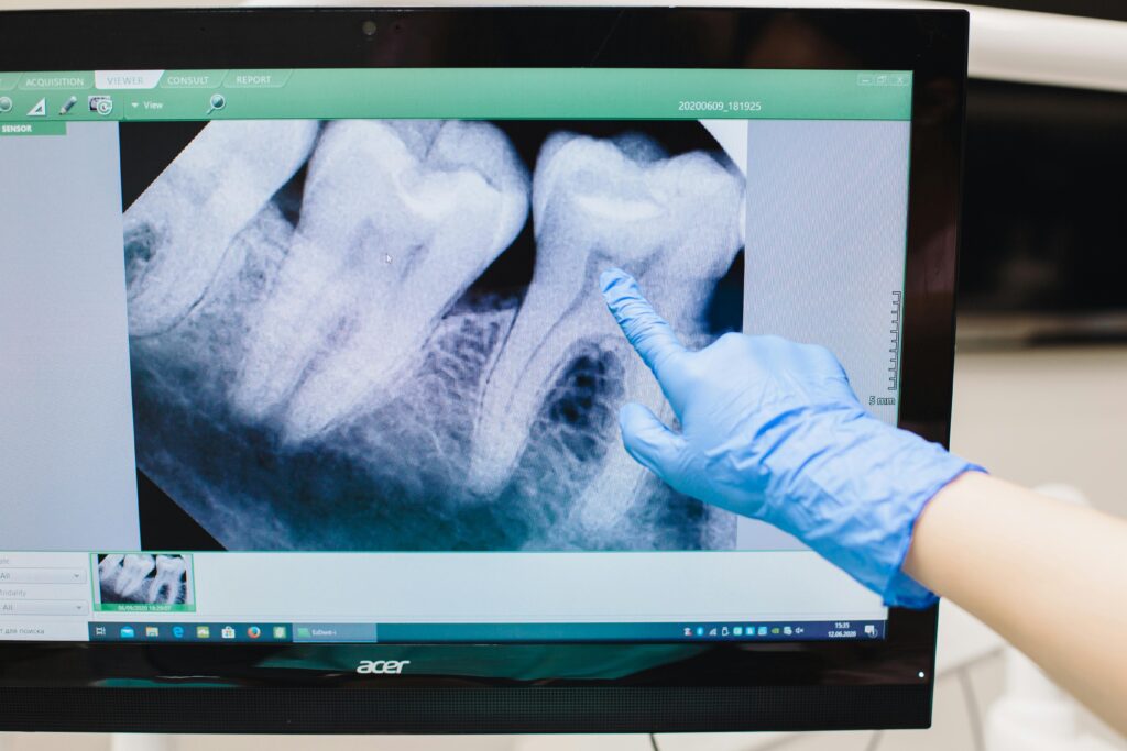 endodontija kanalu gydymas