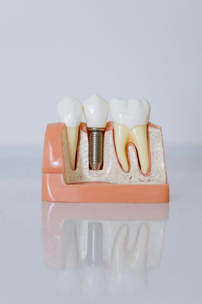 dantu implantacija